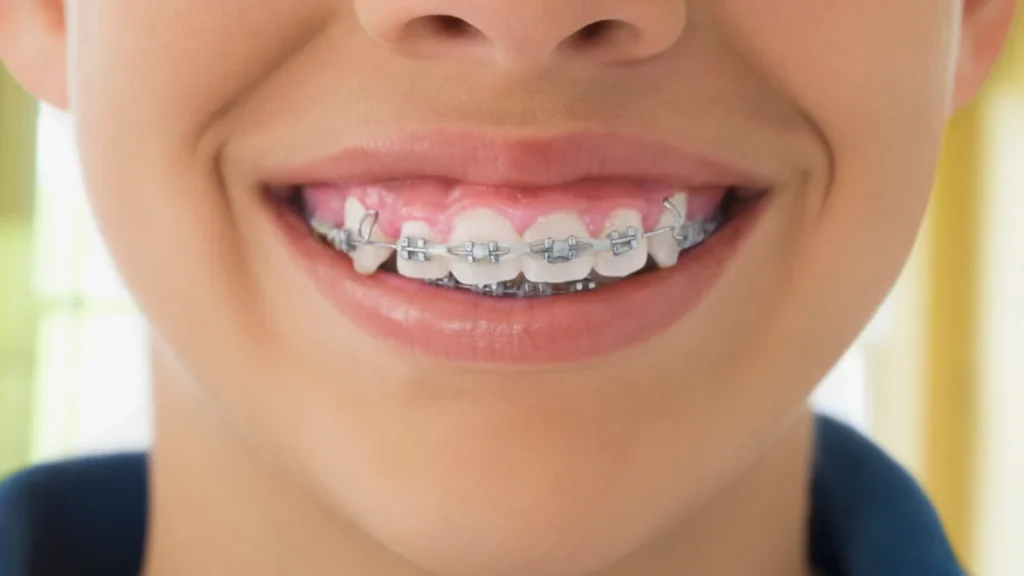 the-evolutionary-mismatch-why-modern-jaws-and-ancient-teeth-require-orthodontic-intervention