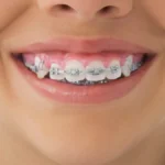 the-evolutionary-mismatch-why-modern-jaws-and-ancient-teeth-require-orthodontic-intervention