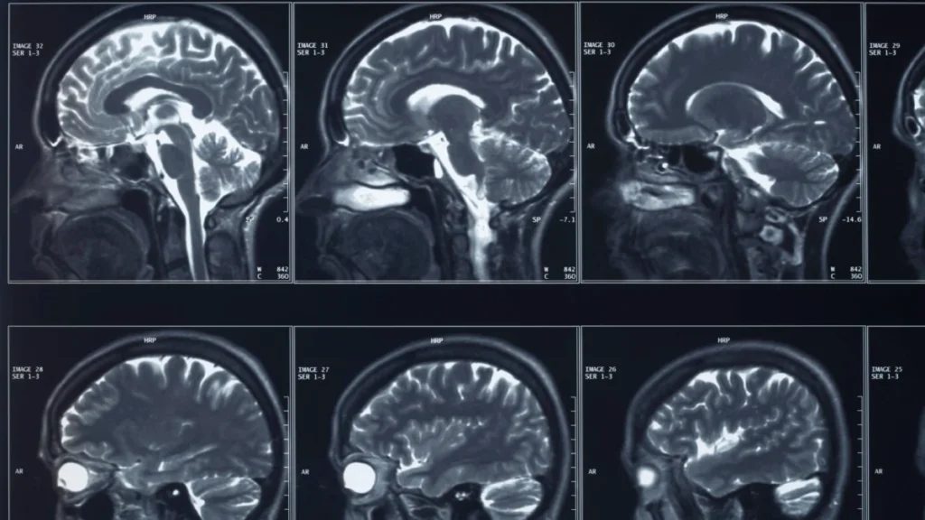 fda-approves-first-human-trial-for-blueberry-sized-brain-implant-targeting-treatment-resistant-depression