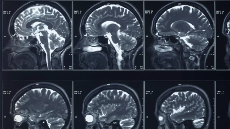 fda-approves-first-human-trial-for-blueberry-sized-brain-implant-targeting-treatment-resistant-depression
