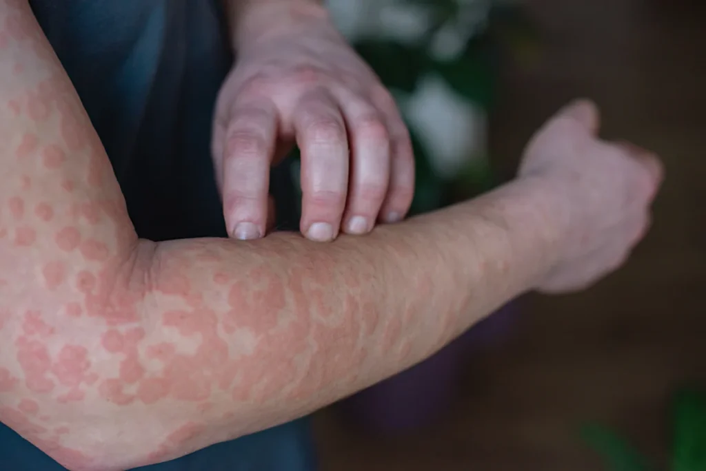 Close-up view , covered in red, itchy rash with fingers frantically scratching inflamed skin