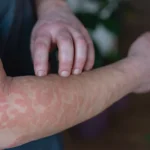Close-up view , covered in red, itchy rash with fingers frantically scratching inflamed skin